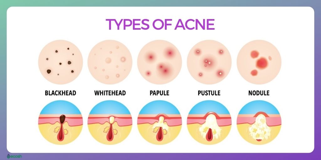 Symptoms and Causes of acne.