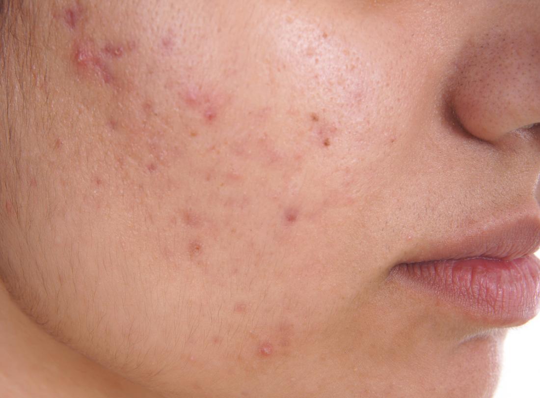 What is acne ?