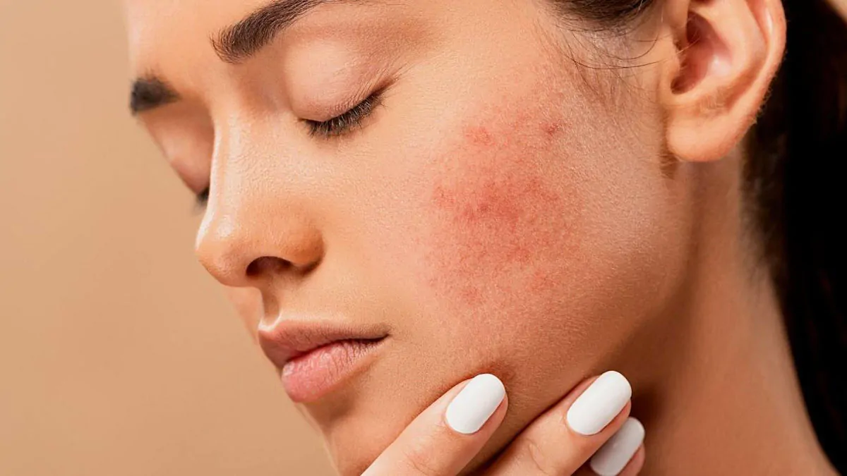 Best acne treatment for skin.